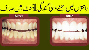 You do that by brushing your teeth at least twice a day. How To Remove Tartar From Teeth Without Dentist In Hindi Teethwalls