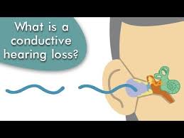 Check spelling or type a new query. Conductive Hearing Loss Explained Youtube