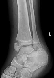 The icd10 diagnosis code that is used for the fracture of medial malleolus is s82.5. Isolated Medial Malleolar Injury Radiology Case Radiopaedia Org