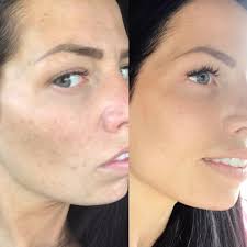 Does your skin need a moisture boost after summer?