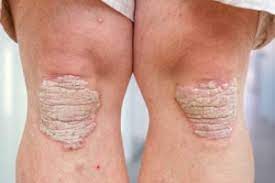 Consult your healthcare professional (e.g., doctor or pharmacist) for more in. If You Have Psoriasis Watch For Early Signs Of Psoriatic Arthritis Health Essentials From Cleveland Clinic