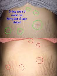 After gastric bypass surgery, you will have five or six small incisions that need to be cared for in the days and weeks after gastric bypass scars: Before And After Sleeve Scars Gastric Sleeve Surgery Forums Bariatricpal