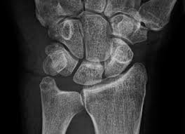 Image result for Pisiform Bone