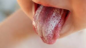 Image result for Canker sores symptoms roof of the mouth