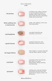 Image result for Pitting nails feet