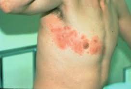 Image result for herpes zoster
