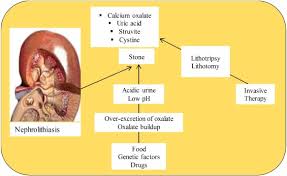Image result for Calcium Nephrolithiasis