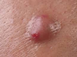 Image result for Cyst