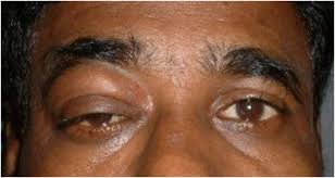 Image result for Proptosis