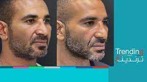 فرح موسى وحلاوتهم من مسلسل موسى. ÙƒÙŠÙ ÙŠØ¨Ø¯Ùˆ Ø§Ù„ÙÙ†Ø§Ù† Ø§Ù„Ù…ØµØ±ÙŠ Ø£Ø­Ù…Ø¯ Ø³Ø¹Ø¯ Ø¨Ø¹Ø¯ Ø¹Ù…Ù„ÙŠØ© Ù†Ø­Øª Ø§Ù„ÙˆØ¬Ù‡ Bbc News Ø¹Ø±Ø¨ÙŠ