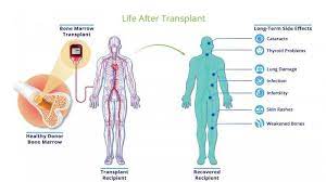 Transplantasi sumsum tulang telah berhasil digunakan untuk mengobati penyakit seperti leukemia, limfoma, anemia aplastik, gangguan defisiensi imun, dan beberapa kanker. Bagaimana Proses Transplantasi Sumsum Tulang Belakang Seperti Yang Akan Dilakukan Ani Yudhoyono Halaman 2 Tribun Jabar