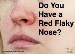 Do You Have A Red Flaky Nose Dry Nose Skin Flaking Skin Flaky Skin On Face