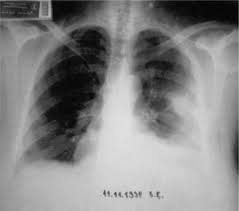Learn about pleural effusion (fluid in the lung) symptoms like shortness of breath and chest pain. References In A New Radiologic Appearance Of Pulmonary Thromboembolism Chest