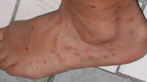 Humans do not have fur or feathers like other animals and birds, which allow them to lay eggs and repopulate on a regular cycle. Fleas On Humans Symptoms Treatment Prevention Pestseek