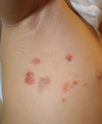 Image result for Impetigo