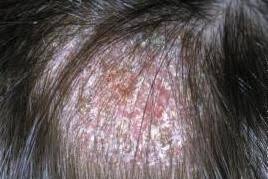 This may be worth investigating if you are concerned. Pin On Dry Scalp