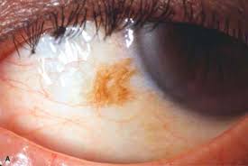 Image result for melanosis sclera