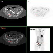 However, as with other types of cancer,. Melanoma Wikipedia