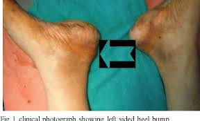 Make sure to give this. Endoscopic Calcaneoplasty For Haglund S Deformity Semantic Scholar