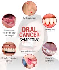 Image result for dental cancer