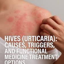 Image result for Hives