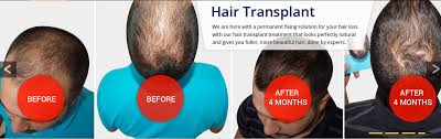 A permanent hair loss solution. Power Packed Tips To Revive Your Attractive Hair Permanently By Aisha Parveen Linkedin