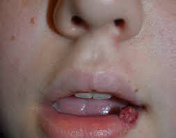Image result for Pyogenic Granuloma