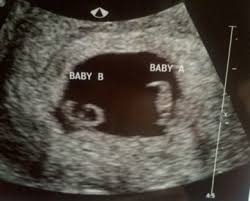 I should be 7 weeks, 4 days according to last period. From New Mexico To Houston How Texas Children S Hospital Saved My Unborn Twin Babies Pavilion For Women
