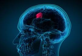 There are an estimated 200,000 cases of brain tumors in the united states alone every year. What Are The Actual Warning Signs Of A Brain Tumor Cleveland Clinic