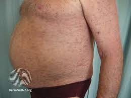 Image result for Leukemia