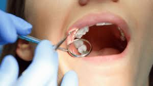 Dental Sealants