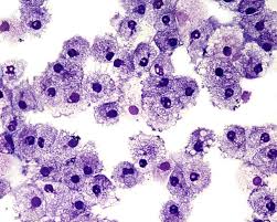 Aml Therapie Prognose Der Leukamie Form