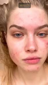 Mandelic Acid Serum hore ma u baroweyse?, 𝐆𝐞𝐭 𝐢𝐧 𝐭𝐨𝐮𝐜𝐡:, 📱 +252  61 1777768, 📱 +252 61 1777769, 📱 +252 61 0743999, 𝐒𝐭𝐨𝐫𝐞𝐬  𝐓𝐢𝐦𝐢𝐧𝐠𝐬:, 𝑺𝒂𝒕𝒖𝒓𝒅𝒂𝒚 𝒕𝒐 𝑻𝒉𝒖𝒓𝒔𝒅𝒂𝒚: 9:30 AM to 10:00  PM, 𝑭𝒓𝒊𝒅𝒂𝒚𝒔: 05 PM to 9:30 PM, ...