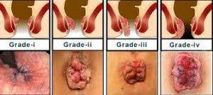 Maybe you would like to learn more about one of these? Hemorrhoids Pictures