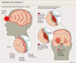 Durant les séjours dans l'espace, l'absence de gravité entraîne une congestion veineuse cérébrale. Une Hemorragie Cerebrale Peut Necessiter Une Operation Planete Sante