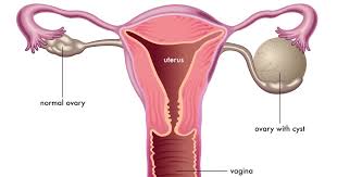 Ovarian cysts are usually benign but, in rare cases, can become cancerous. Rawat Ovarian Cysts Dan Pcos Secara Semulajadi Tanpa Pembedahan Ejen Redoxamin Penang