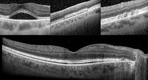 Image result for MEK Inhibitor