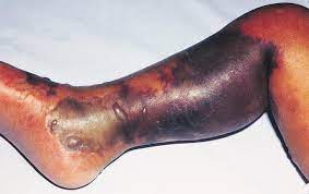 Most cases of necrotizing fasciitis occur randomly. Necrotizing Fasciitis Trauma Orthobullets