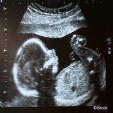 Ihr lieben, ich muss zur feindiagnostik in eine andere praxis und mir wurde geraten frühzeitig den termin zu vereinbaren. Sonografie In Der Schwangerschaft Degum