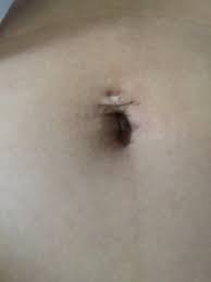 My Naval Piercing Is Saggy After Pregnancy How Could I Fix This Photo