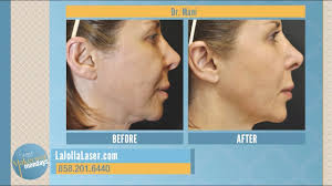 How much do apps cost to make at cleveroad? Ultherapy San Diego Ca La Jolla Ultherapy