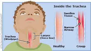 A To Z Croup For Parents Nemours