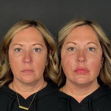 A little enhancement for this pretty woman 🤍✨ 📍 RO Aesthetics 3775 South  Highland Drive, Suite 2 Salt Lake City, UT 84106 📞 Questions or anything  you need: Call/Text 801-233-8778 💻 To