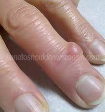 The first step to get rid of your ganglion cyst is to be sure that it is indeed just a ganglion cyst and not something more serious, like a cancerous tumor, so go splint: Ganglion Cysts