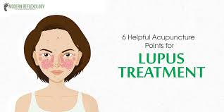 Lupus is a chronic disorder that for. 6 Helpful Acupuncture Points For Lupus Treatment