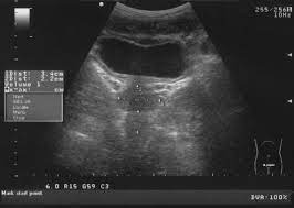 Why You May Need A Full Bladder For That Ultrasound Go Imaging