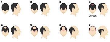 If you have male pattern baldness, you are losing your hair because your body is becoming increasingly sensitive to male sex hormones called androgens. Norwood Scale Pictures Stages Causes And Treatment