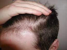 My hair got a little thicker during nofap. Nofap For Hair Regrowth General Discussion Rewire Companion Forum