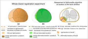 He is the medical director of the sperling prostate center (florida, new york) and the sperling diagnostic group (florida). 3d Registration Of Mpmri For Assessment Of Prostate Cancer Focal Therapy Sciencedirect