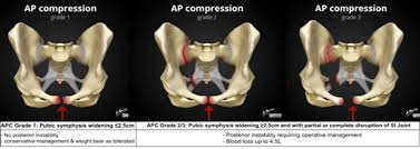 Image result for Pelvic Compression Test